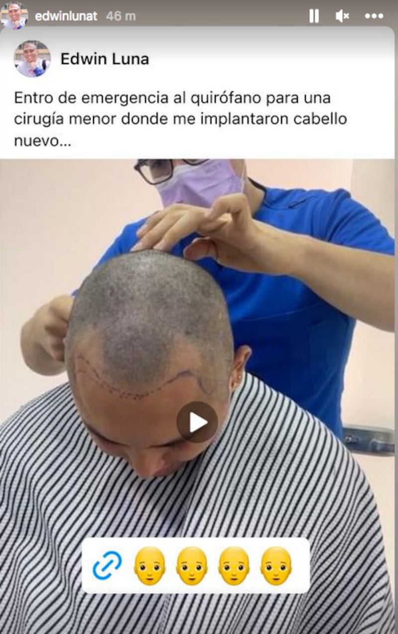 El líder de La Trakalosa se injertó cabello, lo que le valió críticas en las redes sociales.