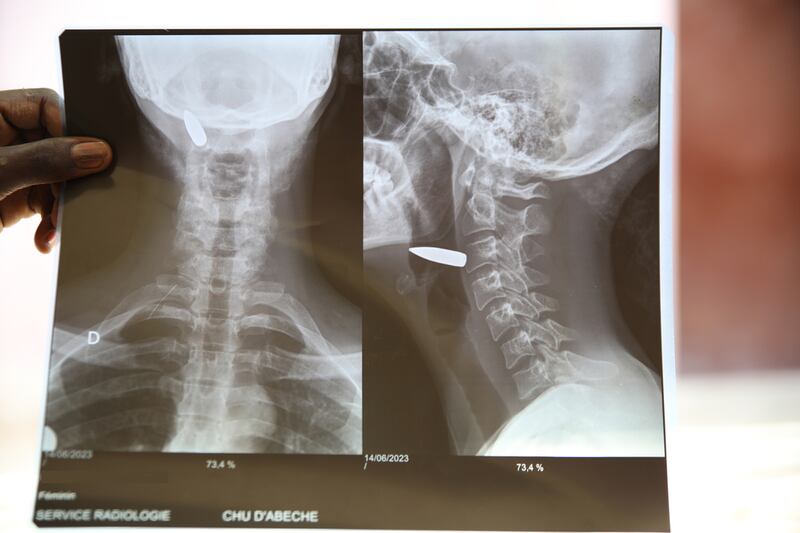 Adré, Chad, junio de 2023. Un médico muestra las radiografías de una mujer que recibió un disparo en el cuello en Sudán antes de llegar a Adré en Chad. Allí, el personal de MSF la operó para extraer la bala, en el hospital de Abéché.