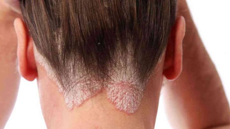 Psoriasis Pustulosa