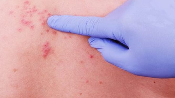 El herpes zóster, la culebrilla, desencadena problemas en la piel.