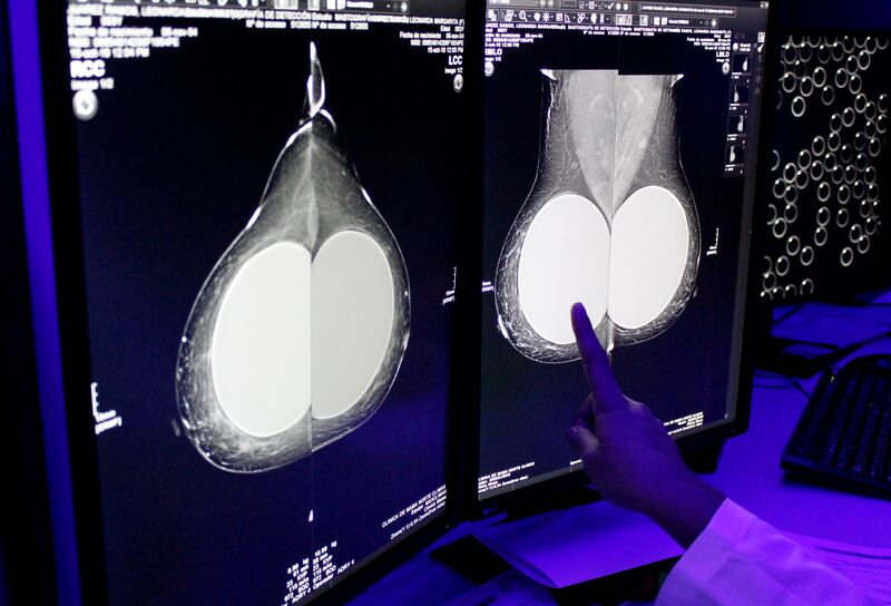 Cáncer de mama en México (Cortesía / IMSS)